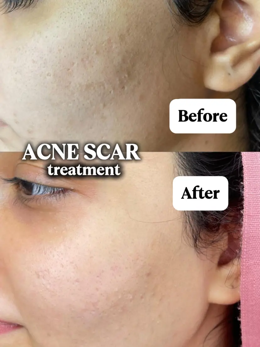 Signature Atrophic Acne Scar Resurfacing — Before and After at Skinsations Lahore