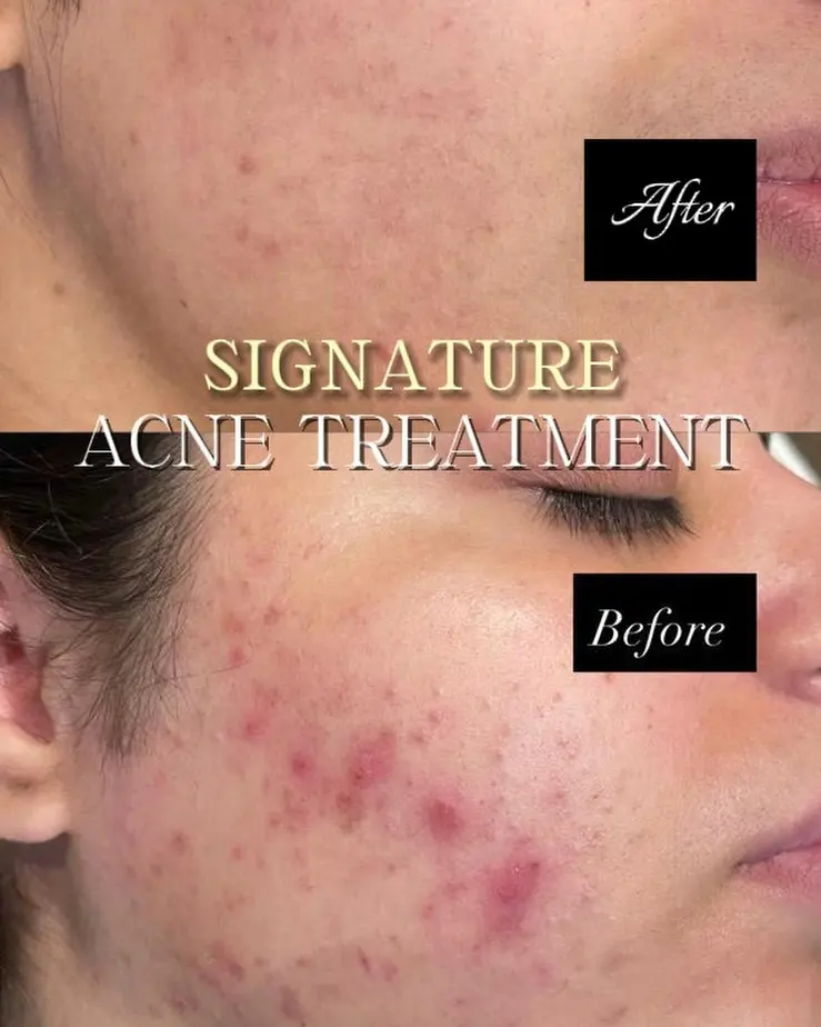 Inflammatory Acne Clearance — 1 Session — Before and After at Skinsations Lahore