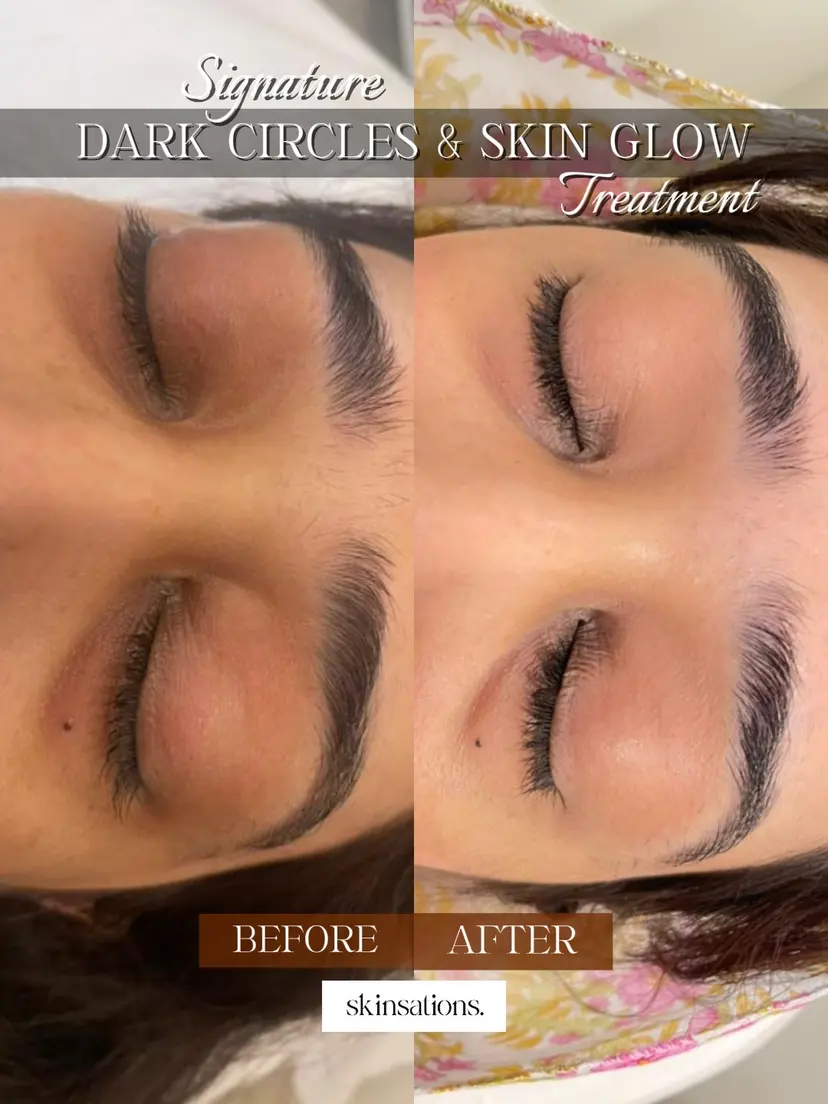 Periorbital Dark Circles & Signature Skin Glow — Before and After at Skinsations Lahore