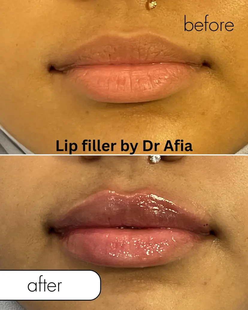 Signature Natural Lip Enhancement — Before and After at Skinsations Lahore