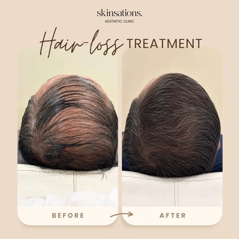 Male Pattern Baldness Density Recovery — Before and After at Skinsations Lahore