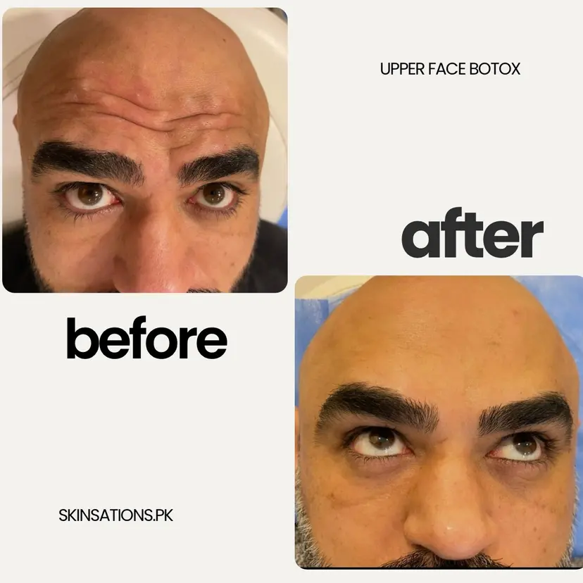 Upper Face Dynamic Line Refresh — Before and After at Skinsations Lahore