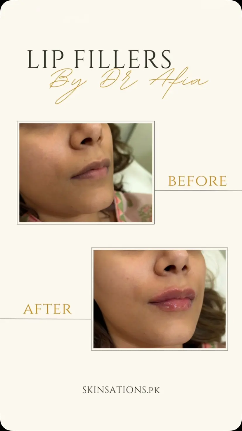 Subtle Lip Enhancement & Natural Definition by Dr. Afia